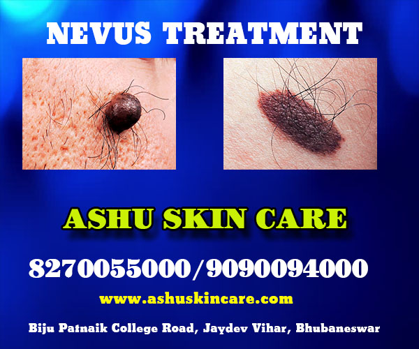 best nevus treatment clinic in bhubaneswar close to sum hospital